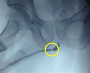 Инновационные методы в лечении стриктуры уретры